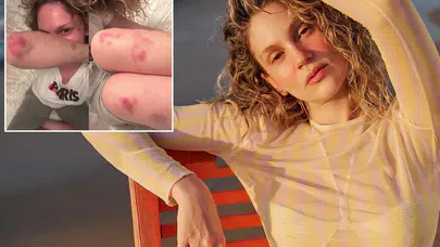 Farah Zeynep Abdullah’ın Son Hali Korkuttu! Vücudundaki Morluklar Şaşırttı