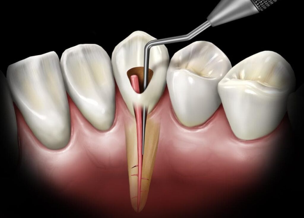 Diş Kanal Tedavisi Nasıl Yapılır