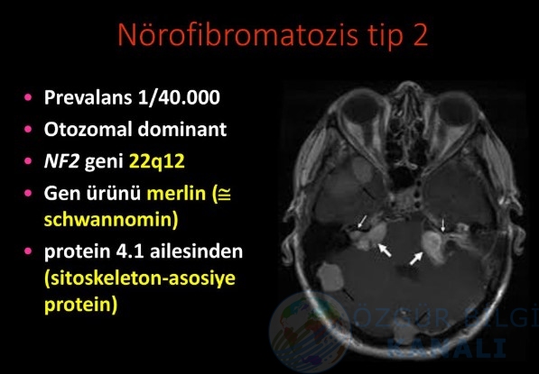 Astrositom ve oligodendrogliom