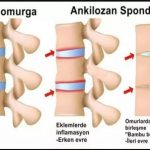 Ankilozan Spondilit (AS)