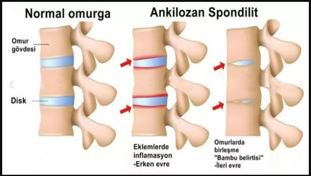 Ankilozan Spondilit (AS)