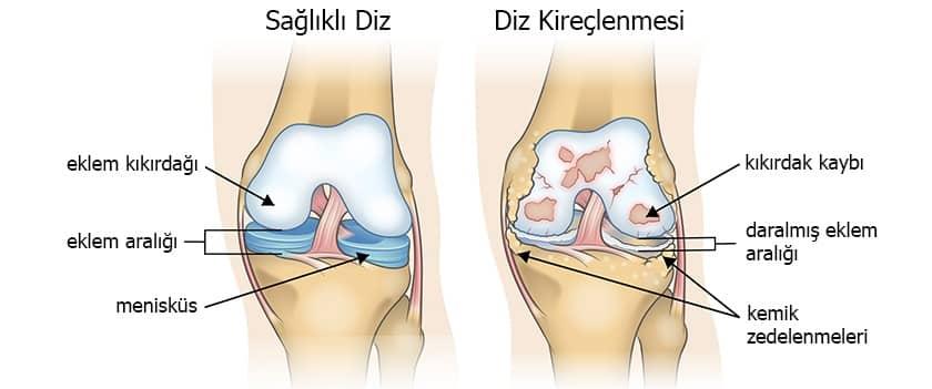 Tedavi seçenekleri: İlaçlar,Fizik Tedavi ve Cerrahi Yaklaşımlar